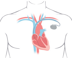 Drawing of an anatomical heart in a man's chest with a monitor lead
